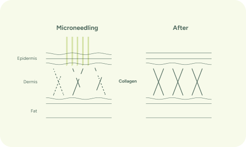 Microneedling infographic